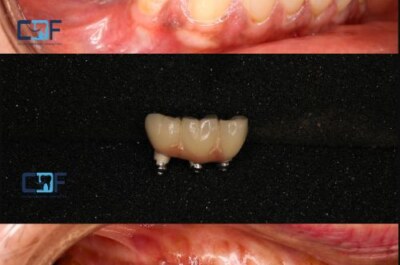 Dental Implants Treatment in Coimbatore | Coimbatore Dental Foundation